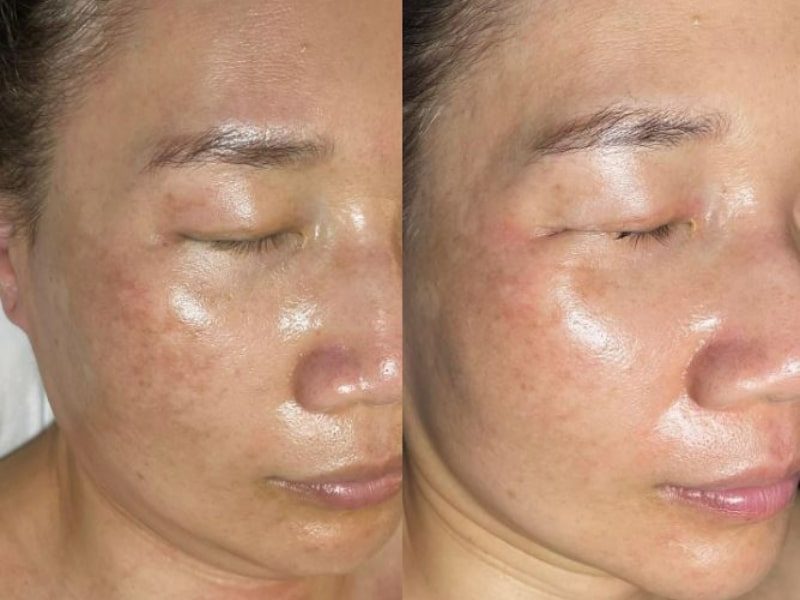  glycolic acid is highly effective at removing dead skill cells and fading hyperpigmentation.