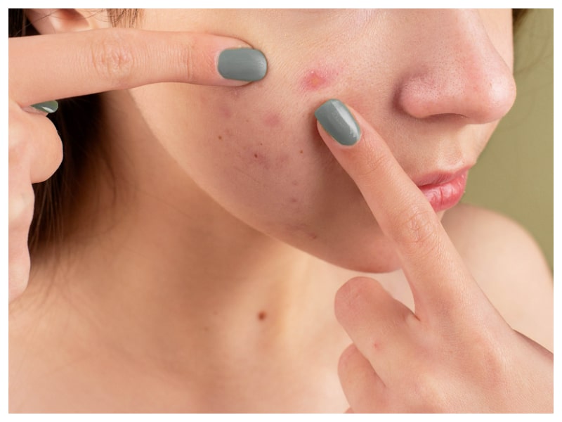 What Is Sensitive SkinSensitive skin means your skin is more prone to reactions or easily irritated. 