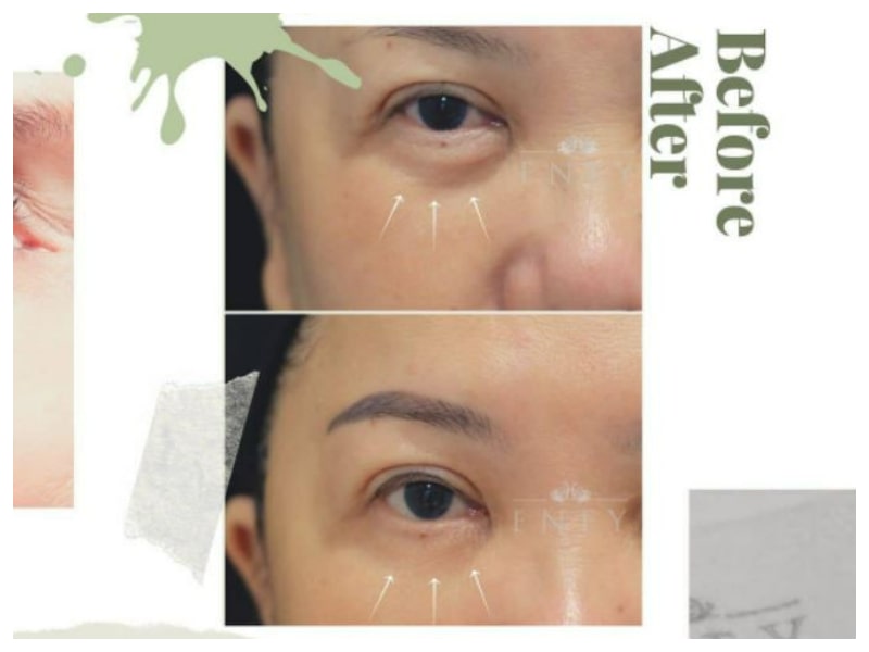 Botox injections are also an effective treatment for eye bag removal. 