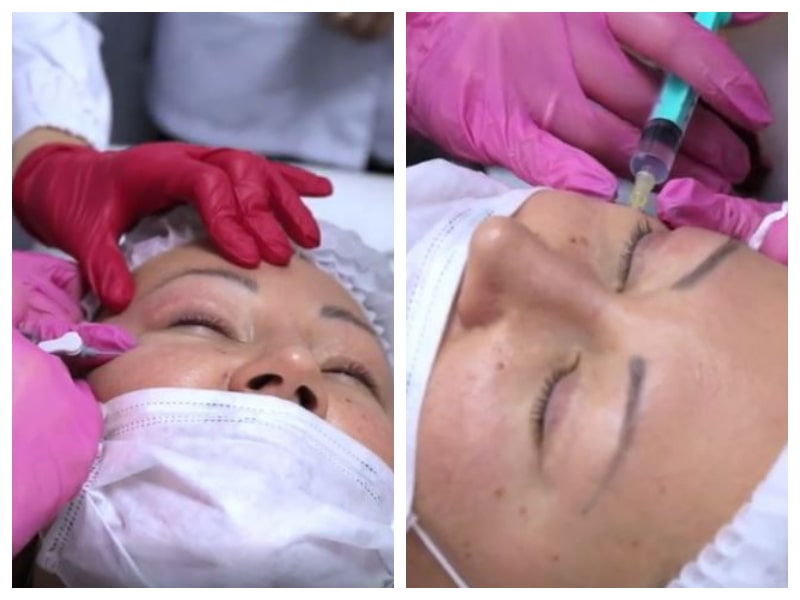 Innofill RF is a must-have eye bag removal treatment if you want to look completely awake 