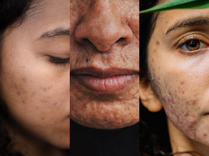 acne scars types