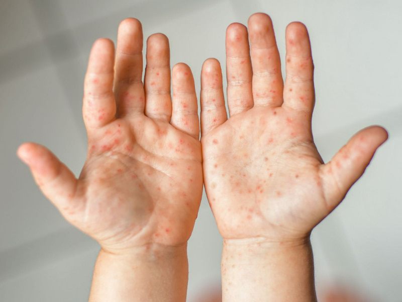 hand, foot, and mouth disease