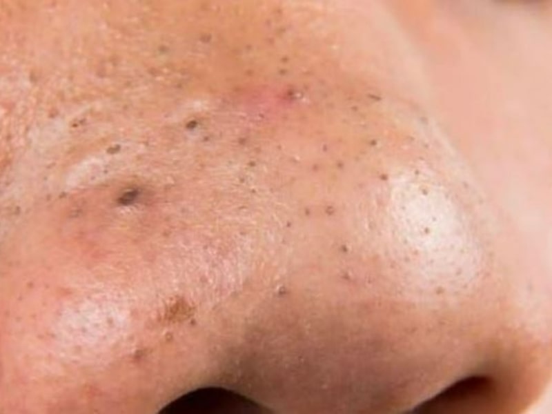 Bintik hitam atau blackhead adalah sejenis jerawat di muka (acne vulgaris) yang dialami oleh hampir semua orang